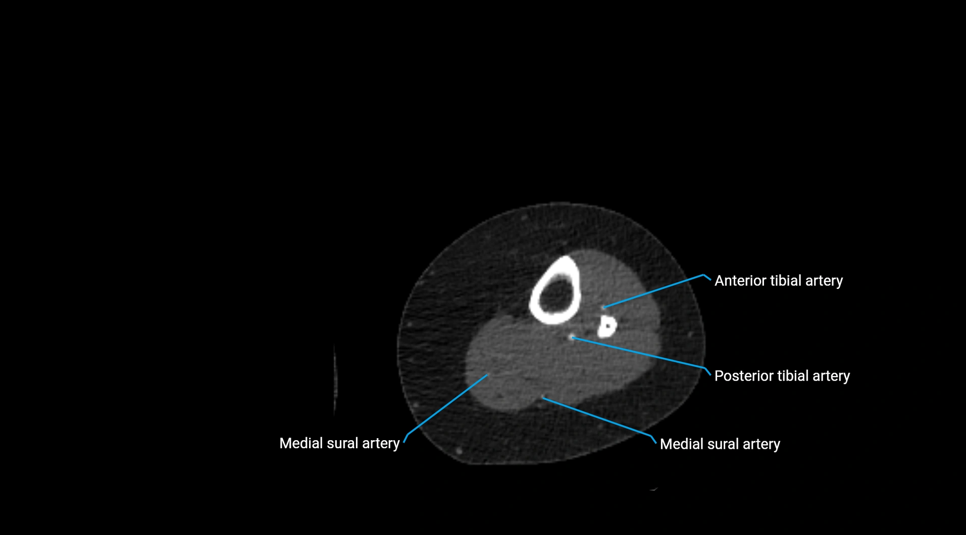 CTA lower limb cross sectional anatomy labelled image _199.webp